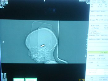 Iraqi Injured Boy – Bullet in the head